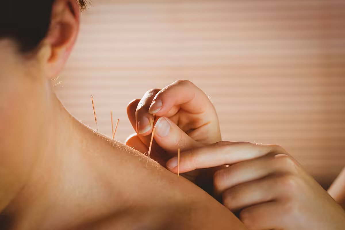 Acupuncture needles inserted into a patient's upper back during a treatment session covered by ASEBP MyRetiree Plan