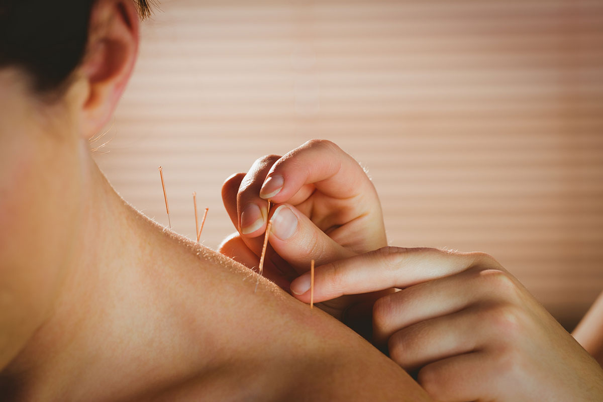Acupuncture needles inserted into a patient's upper back during a treatment session covered by ASEBP MyRetiree Plan