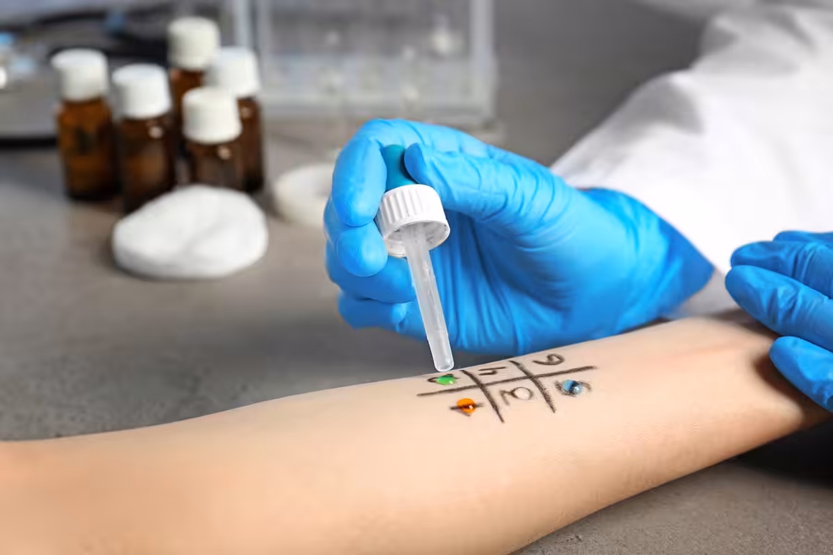 Healthcare professional administering allergy skin prick test on forearm with labeled grid and colored allergen drops