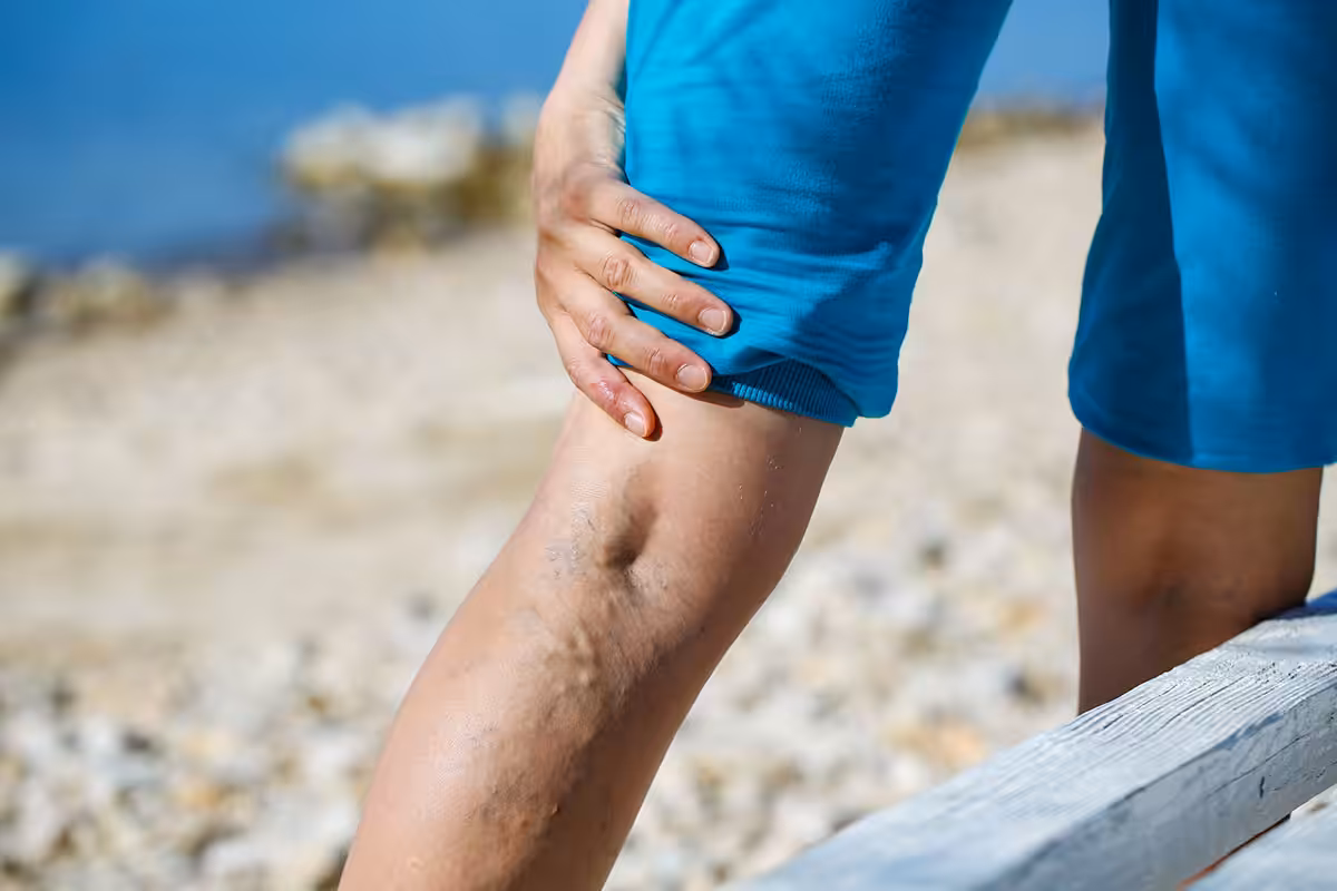 Varicose veins on an older adult's lower leg, a condition covered under ASEBP MyRetiree Plan extended health benefits