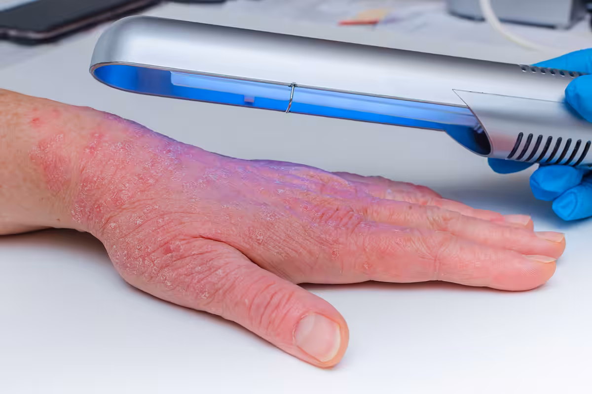 UV light therapy device treating severe psoriasis on a hand, covered under ASEBP MyRetiree Plan extended health benefits